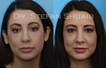 female patient before and after Rhinoplasty