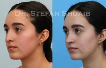 female patient before and after Rhinoplasty