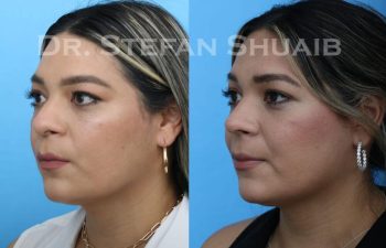 female patient before and after Rhinoplasty