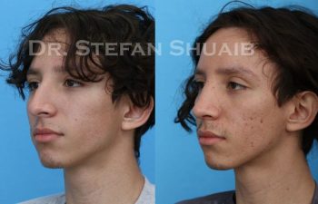 male patient before and after Rhinoplasty