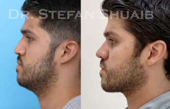 male patient before and after Rhinoplasty