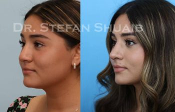 female patient before and after Rhinoplasty