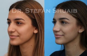 female patient before and after Rhinoplasty