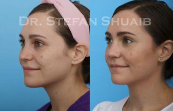 female patient before and after Rhinoplasty