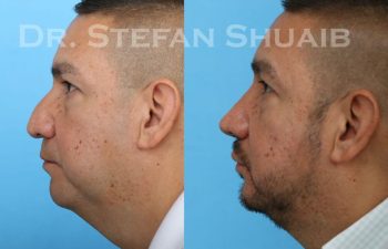 male patient before and after Rhinoplasty