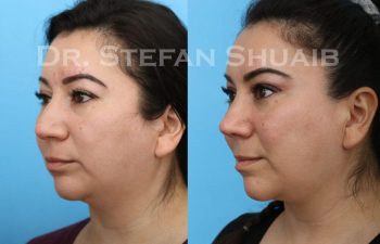 female patient before and after Rhinoplasty