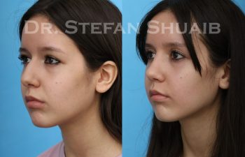 female patient before and after Rhinoplasty