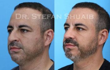 male patient before and after Rhinoplasty