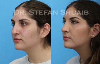 female patient before and after Rhinoplasty