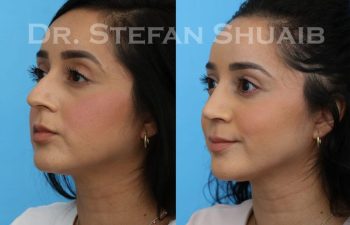 female patient before and after Rhinoplasty