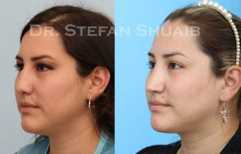 female patient before and after Rhinoplasty