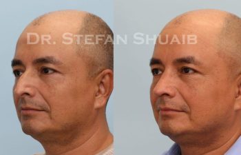 male patient before and after Rhinoplasty