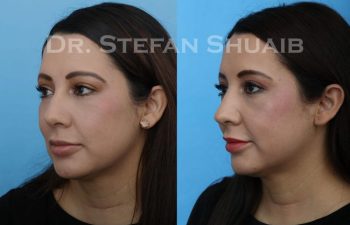 female patient before and after Rhinoplasty