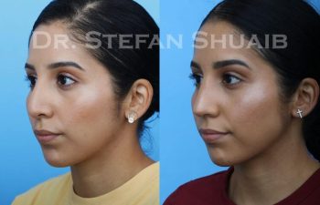 female patient before and after Rhinoplasty