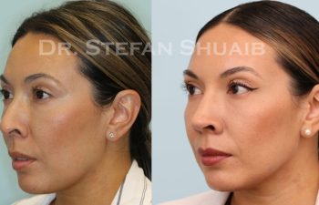 female patient before and after Rhinoplasty