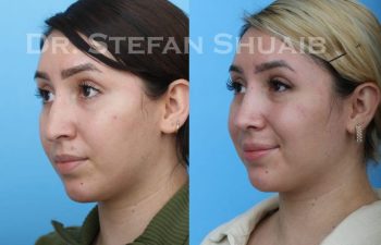 female patient before and after Rhinoplasty