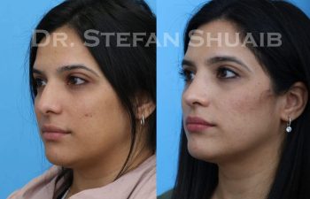 female patient before and after Rhinoplasty