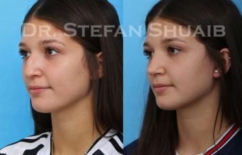 female patient before and after Rhinoplasty