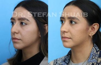 female patient before and after Rhinoplasty