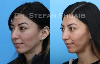 female patient before and after Rhinoplasty