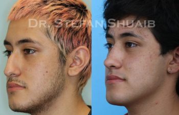 male patient before and after Rhinoplasty