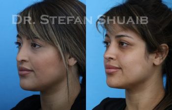 female patient before and after Rhinoplasty