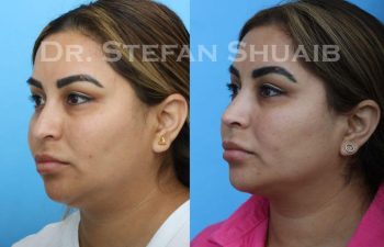 female patient before and after Rhinoplasty