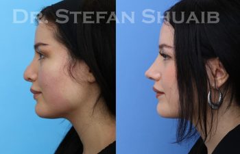 female patient before and after revision rhinoplasty