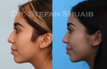 female patient before and after Rhinoplasty