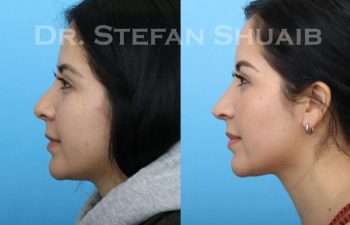 female patient before and after Rhinoplasty