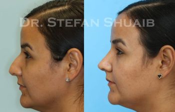 female patient before and after Rhinoplasty