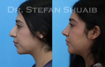 female patient before and after Rhinoplasty