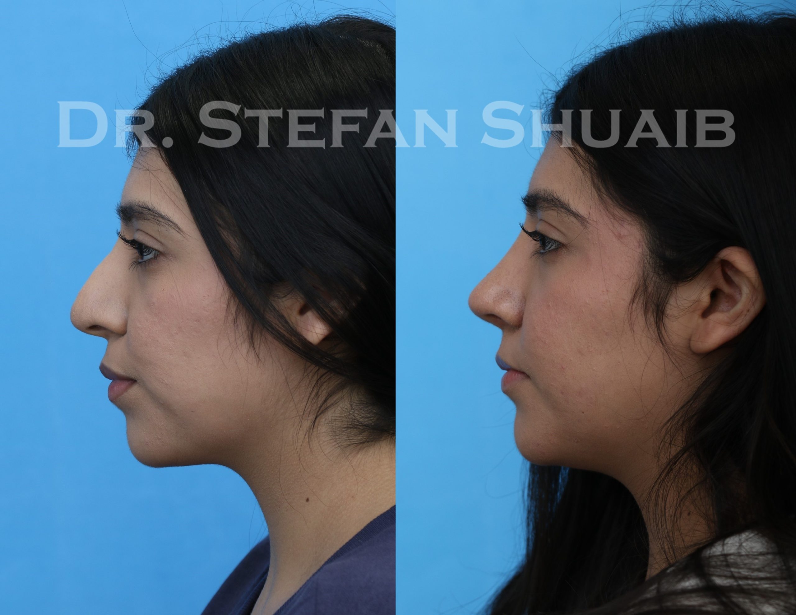 female patient before and after Rhinoplasty