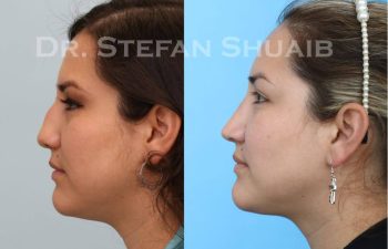 female patient before and after Rhinoplasty