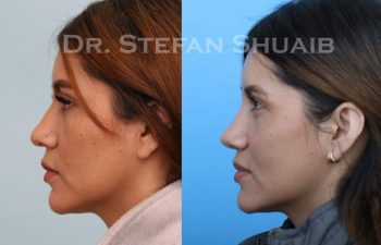 female patient before and after Rhinoplasty