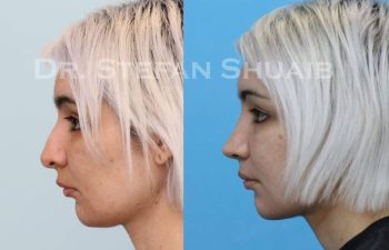 female patient before and after Rhinoplasty