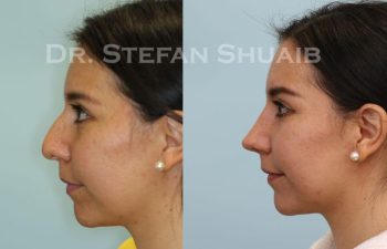 female patient before and after Rhinoplasty