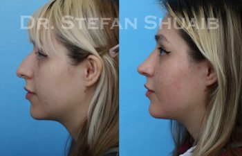 female patient before and after Rhinoplasty