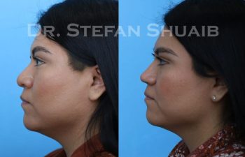 female patient before and after Rhinoplasty