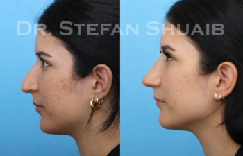 female patient before and after Rhinoplasty