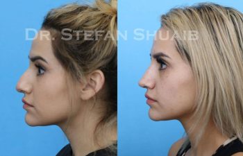 female patient before and after Rhinoplasty