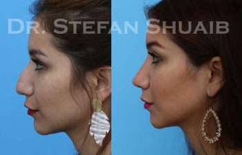 female patient before and after Rhinoplasty