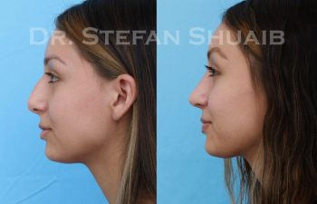 female patient before and after Rhinoplasty