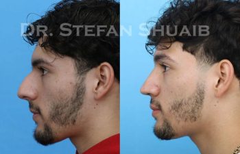 male patient before and after Rhinoplasty