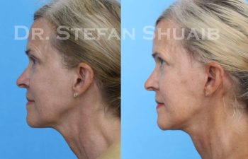 female patient before and after Facial Rejuvenation