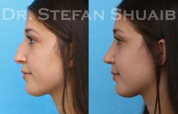 female patient before and after Rhinoplasty