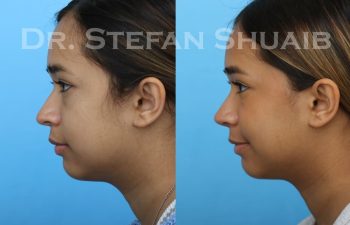 female patient before and after revision rhinoplasty