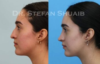 female patient before and after Rhinoplasty