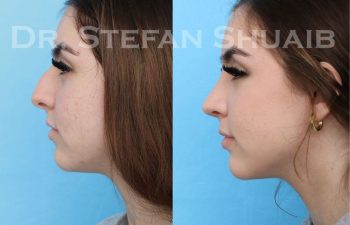 female patient before and after Rhinoplasty