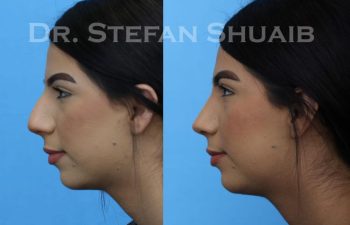 female patient before and after Rhinoplasty